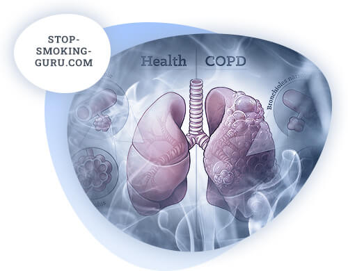 Chronic obstructive pulmonary disease