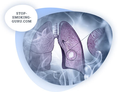 Lung cancer